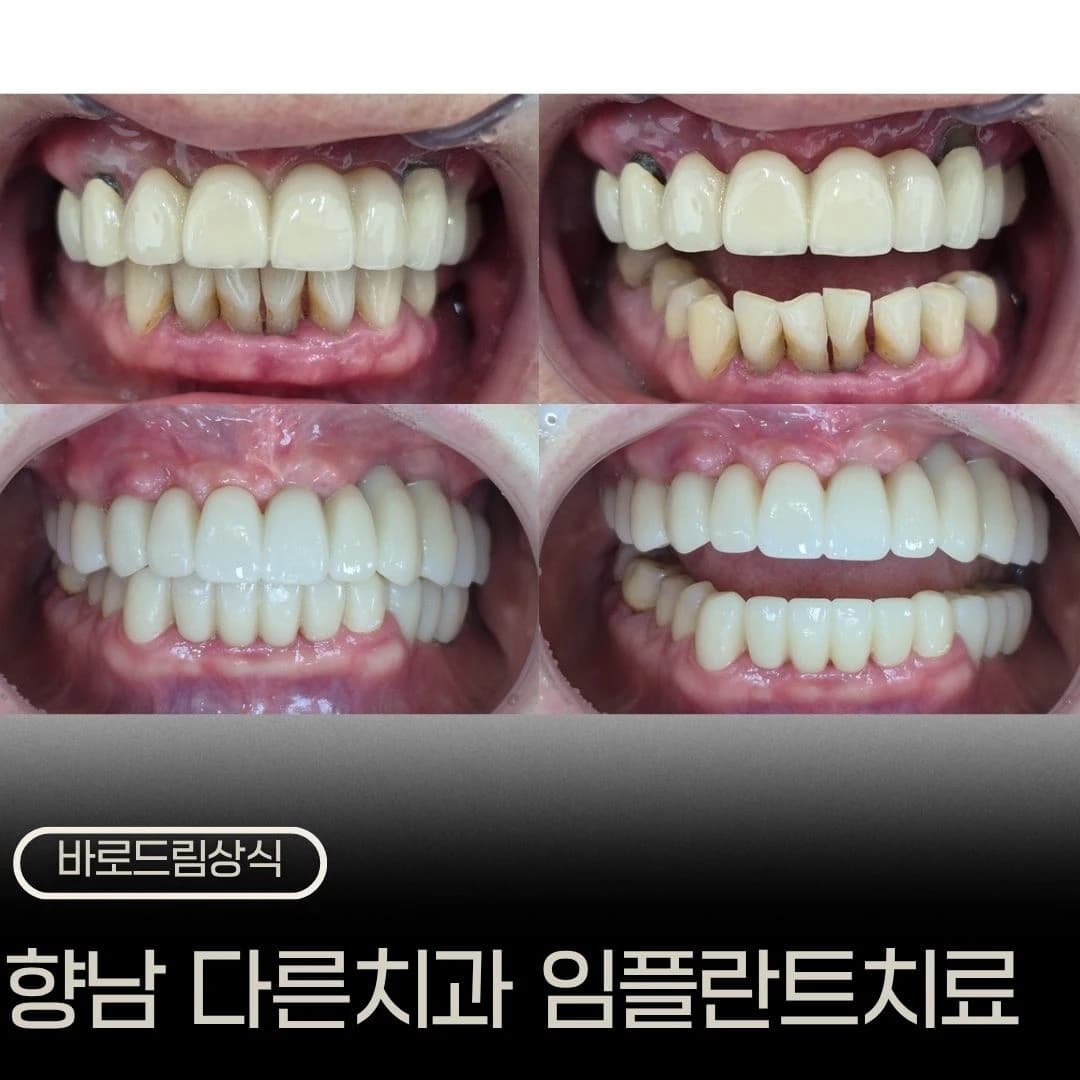 치료 전후 구강사진을 함께 배치한 중단된 임플란트 치료 원문 대표 이미지