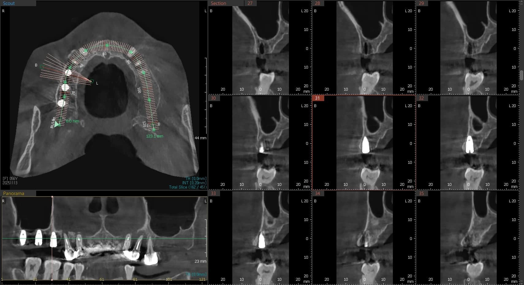 기존 임플란트 위치와 주변 구조를 단면으로 확인한 CT 자료