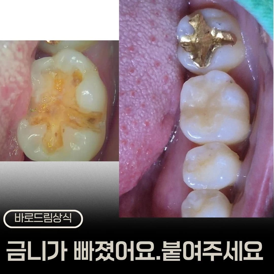 탈락한 금 인레이 부위와 치료 후 구강사진을 배치한 원문 대표 이미지
