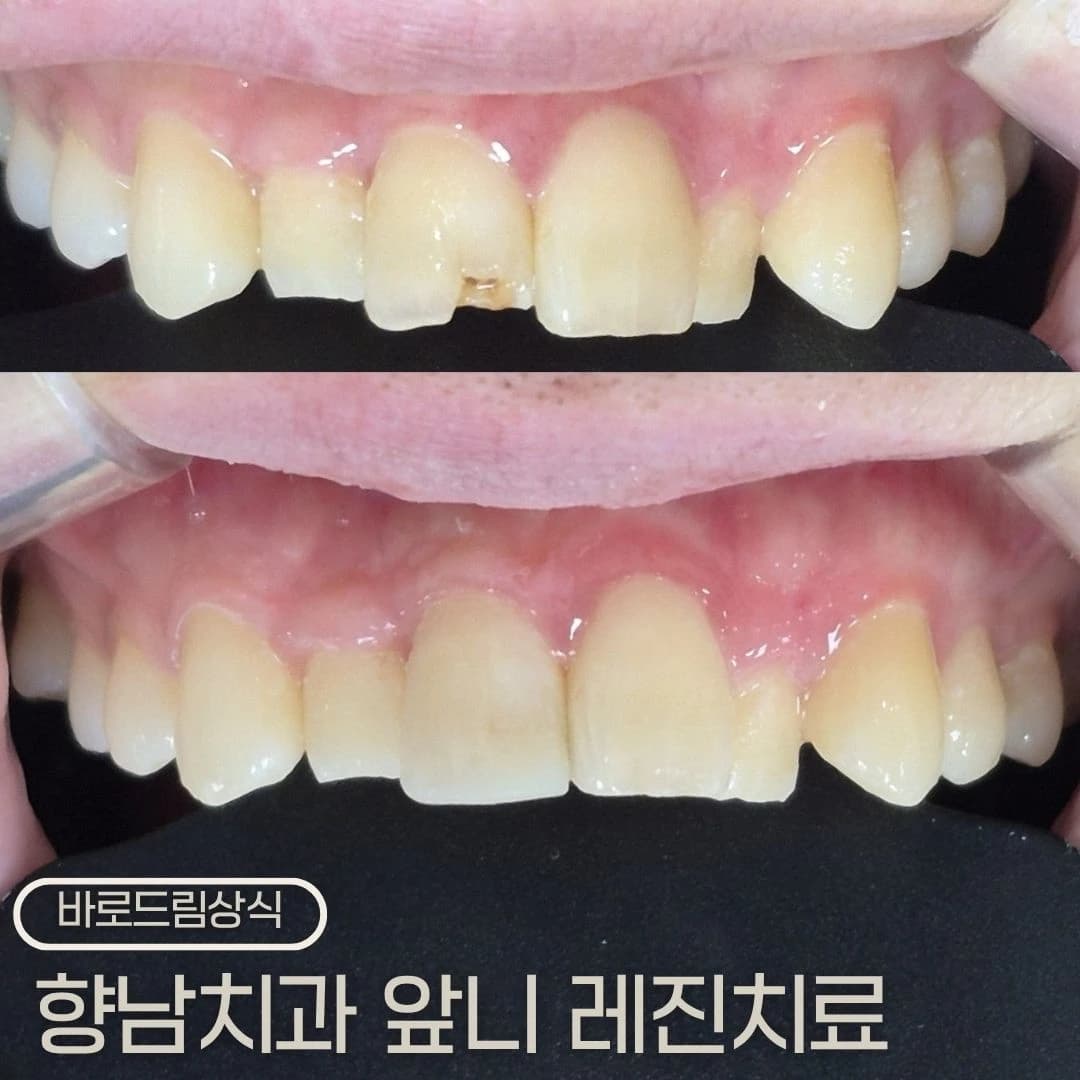 앞니 치료 전후를 배치한 원문 대표 이미지