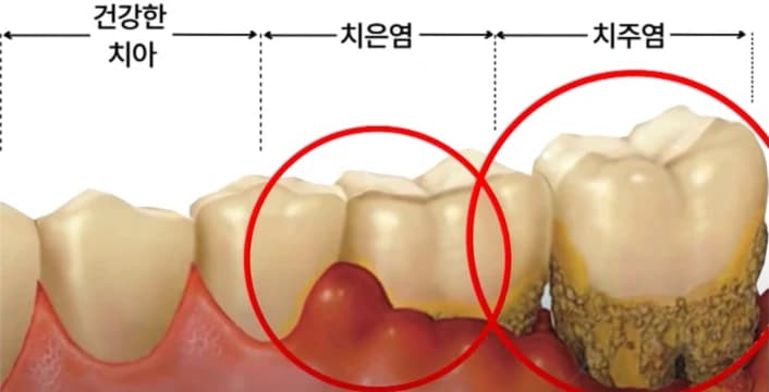 건강한 치아와 치은염 및 치주염 상태를 비교한 그림