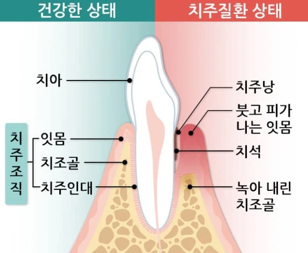 건강한 치주조직과 치주질환 상태를 비교한 단면 그림
