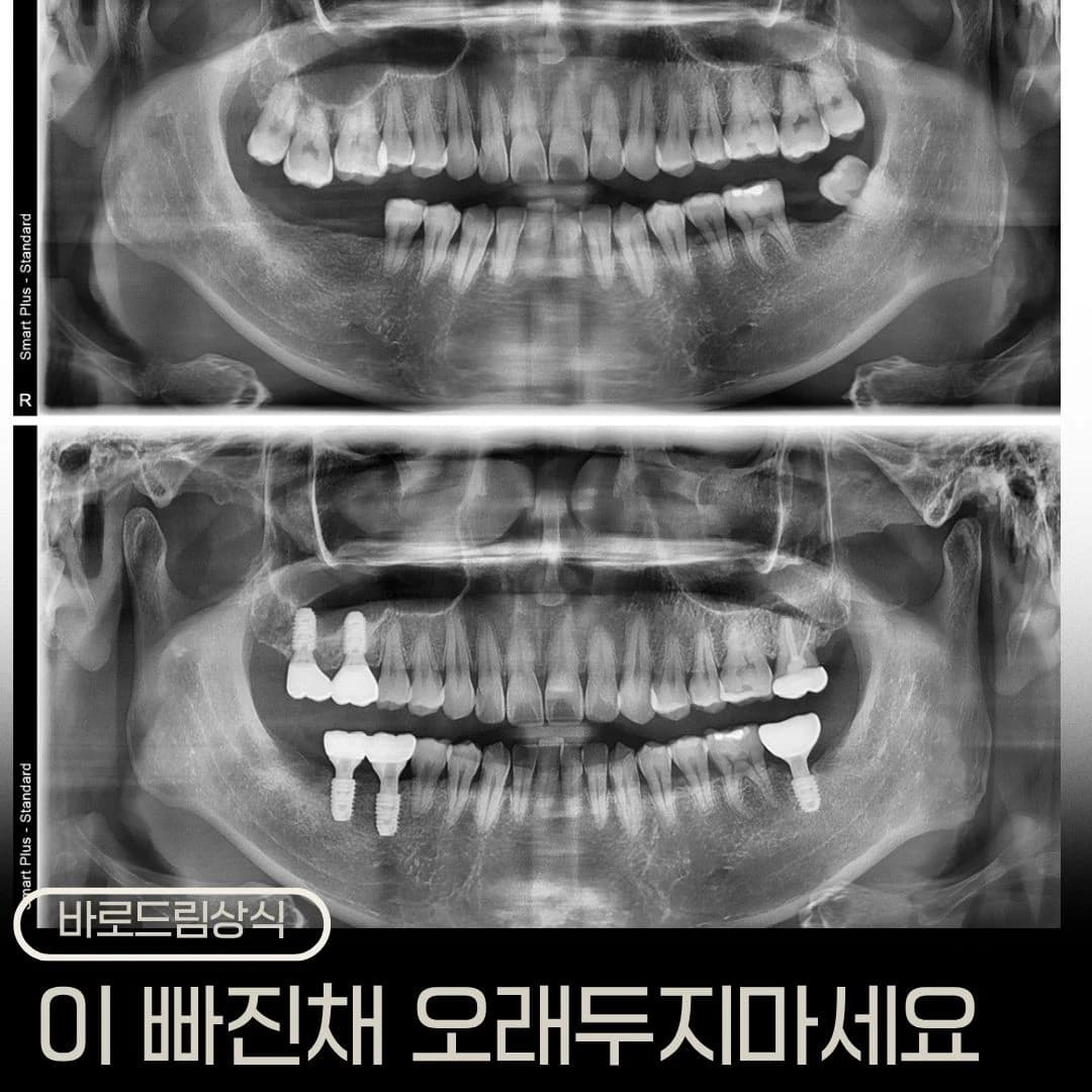 치료 전후 파노라마를 배치한 원문 대표 이미지