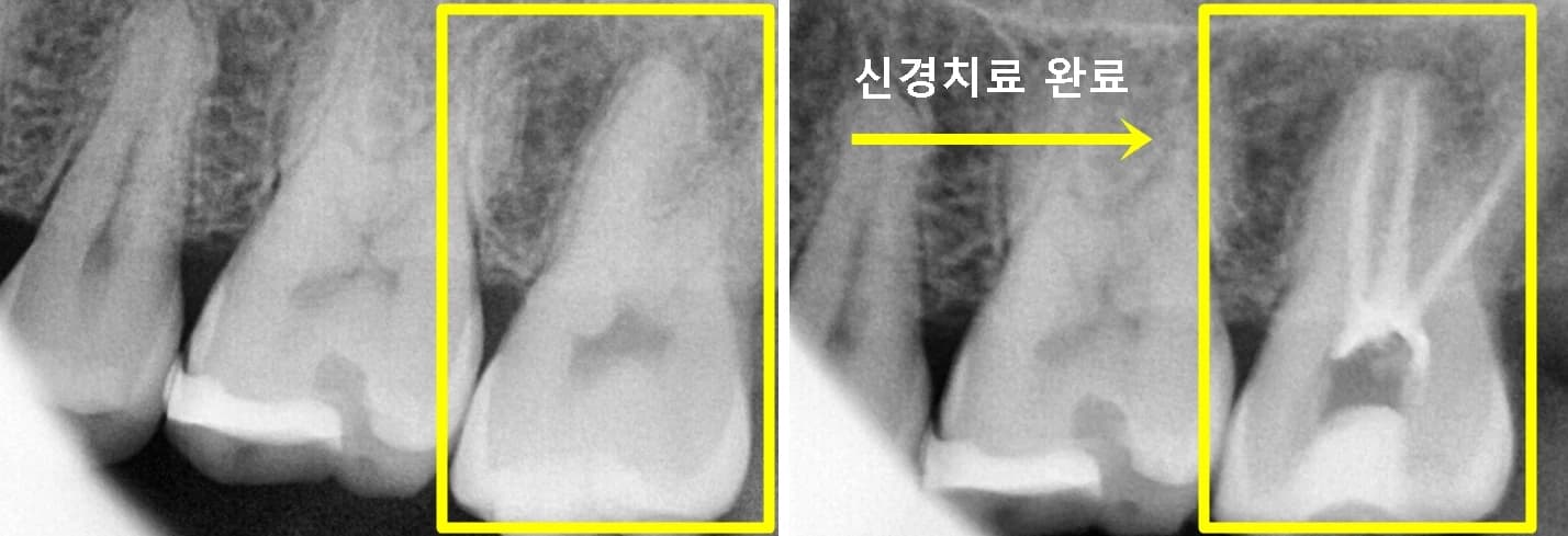 27번 치아의 신경치료 전후를 제시한 방사선 영상