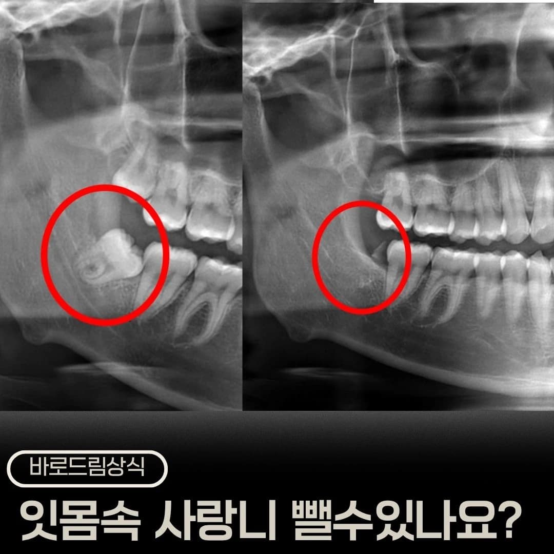 아래 사랑니 부위를 원으로 표시한 원문 방사선 비교 표지