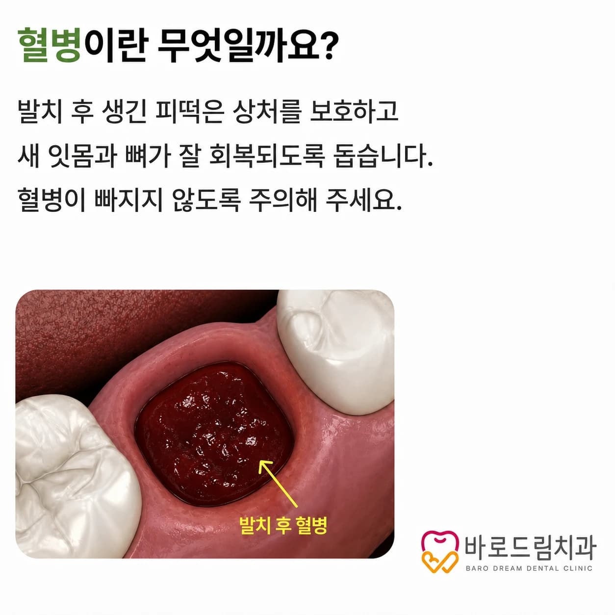 발치 부위를 보호하는 혈병의 역할을 설명한 원문 교육 그림