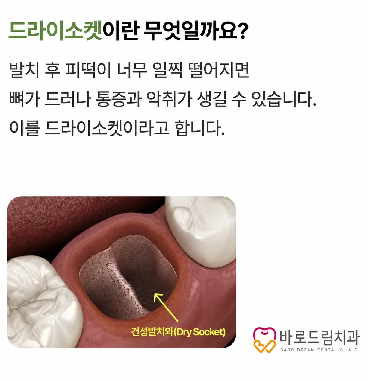 혈병 소실과 드라이소켓을 설명한 원문 교육 그림