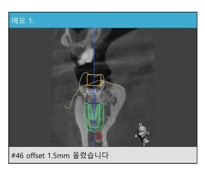 임플란트 위치 조정 계획을 기록한 CT 단면 메모