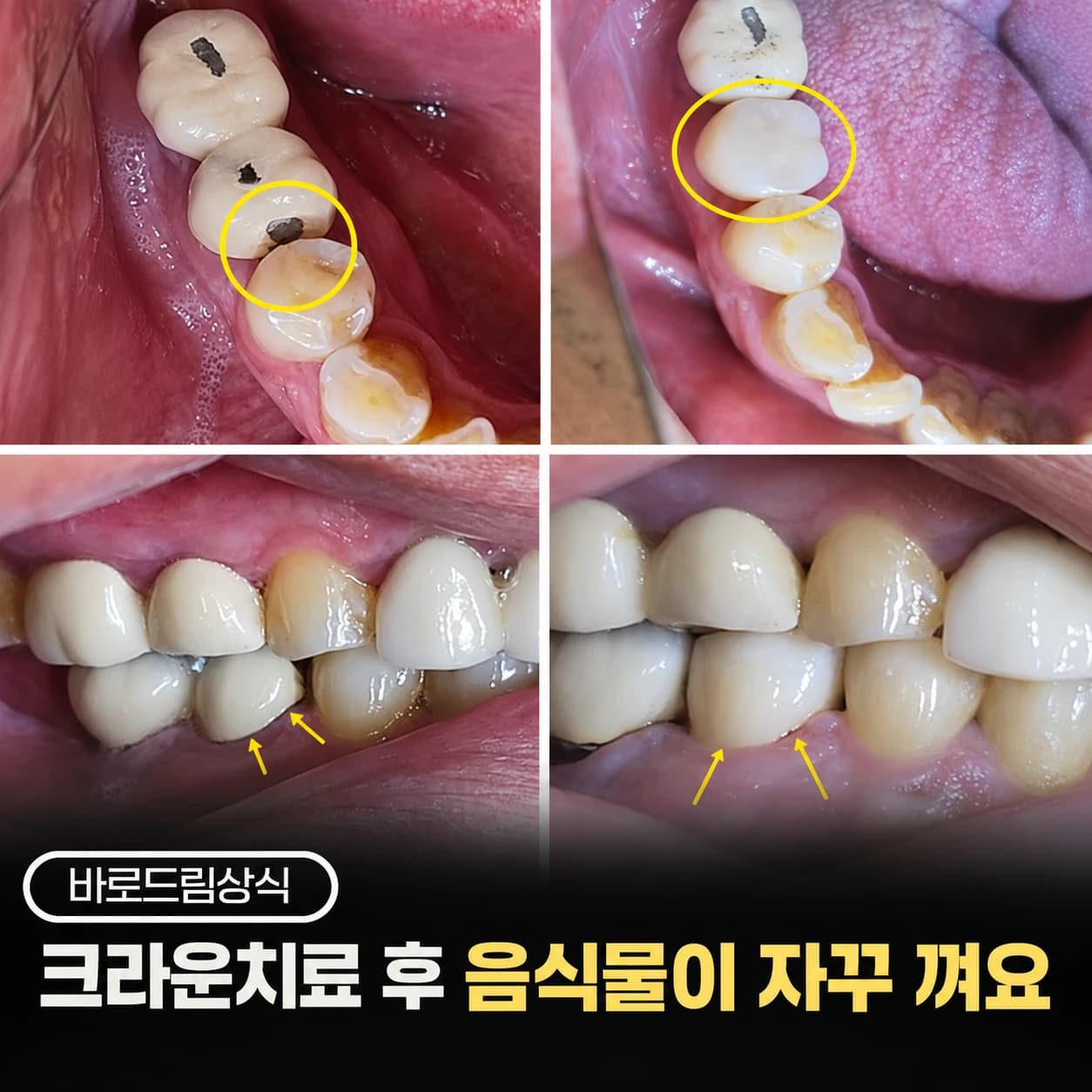 크라운 주변 음식물 끼임을 설명하는 치료 전후 구강사진 모음