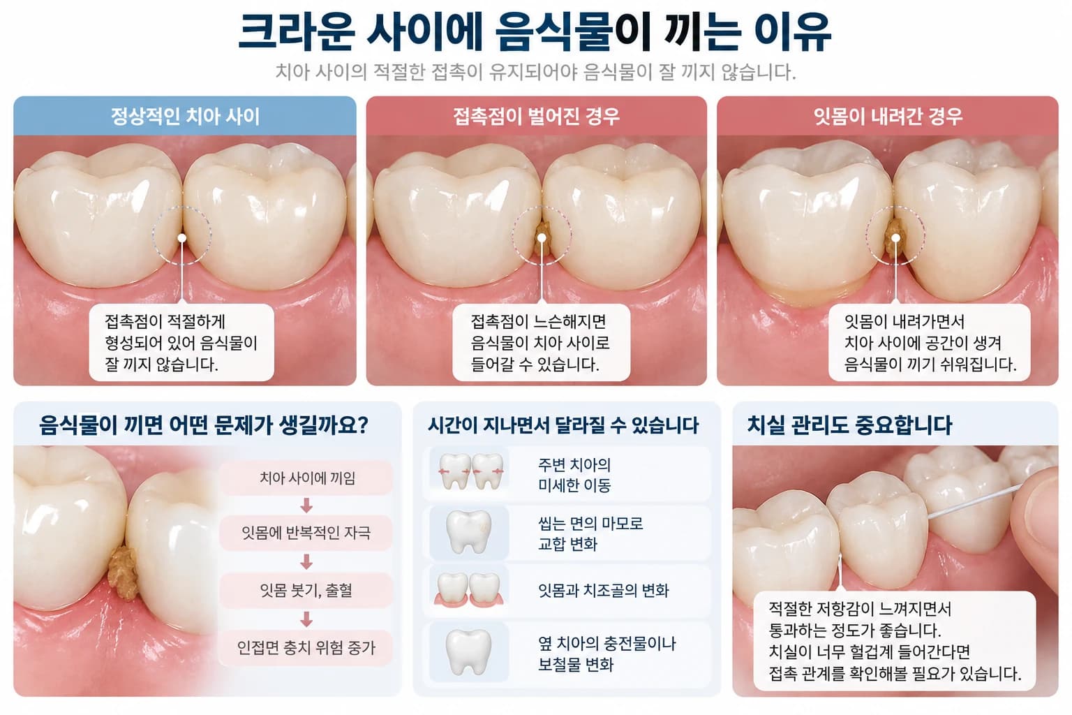 크라운 사이 음식물 끼임의 원인과 관리 방법을 정리한 원문 교육 그림