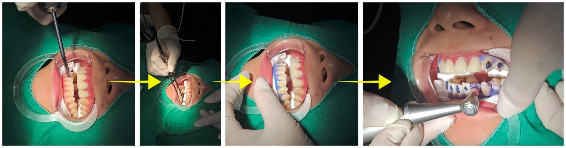 향남치과 향남치아미백 진행 과정 1 — 구강 상태와 색 확인, 치석·겉 착색 제거, 잇몸 보호재 도포, 보호재 경화